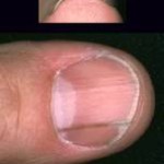 Vanliga nagelproblem