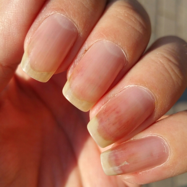 nagel släpper från nagelbädden