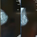 Bilder från mammografin